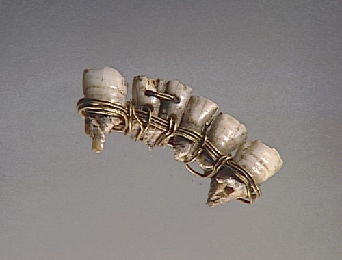 Dental bridge