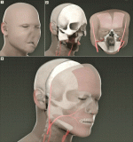 face transplant