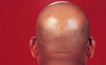 Bald_1655259c