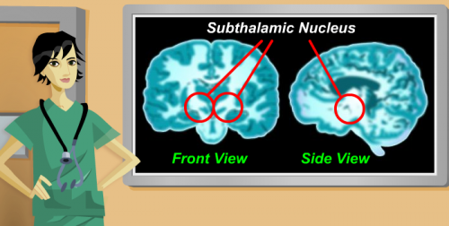 brainsurgery