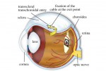 eye implant