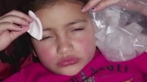 botox