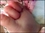 110711053316_swollen-toes_0