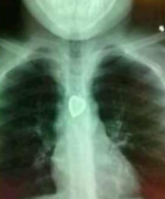 x-ray
