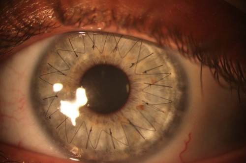eyestitches