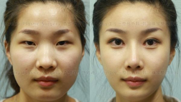 asian surgery to look western