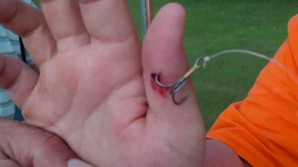 How To Remove A Fish Hook From Your Skin In Three Easy Steps - Neatorama